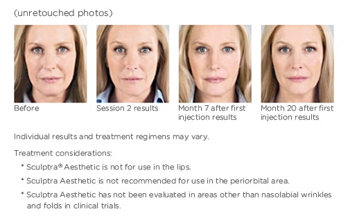 SculptraPhotoImageTransformationElissa