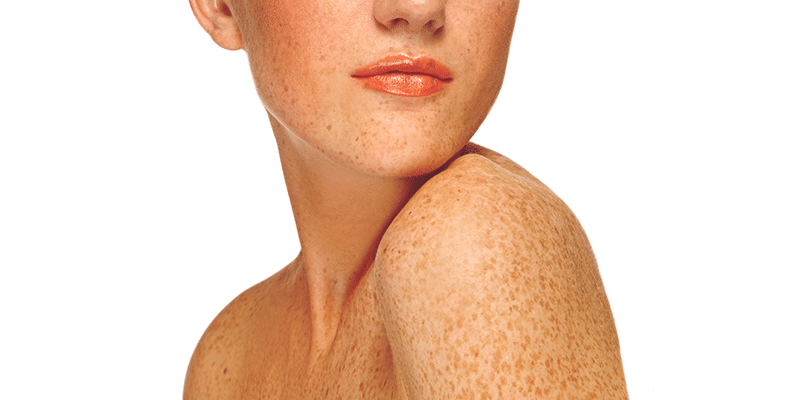 NW Face, Melanoma - Image