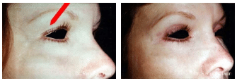 2016-11-11-10_50_25-blepharoplasty-before-after-gallery