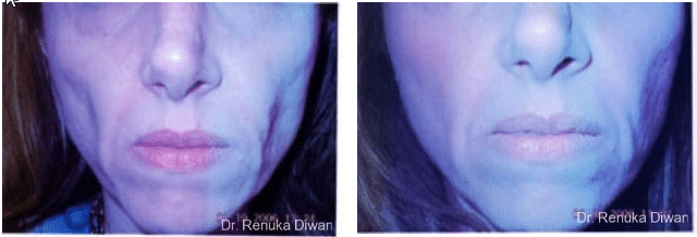 2016-11-17-10_59_34-loss-of-fullness-before-after-gallery