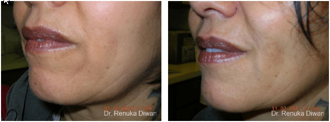 2016-11-17-10_59_50-loss-of-fullness-before-after-gallery