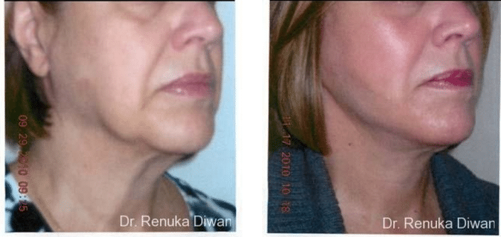 close up of the front of a woman's face showing before and after a facelift procedure