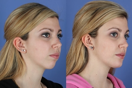 Chin Implants Cleveland, Ohio | The Laser & Skin Surgery Center