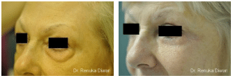 2016-11-11-10_51_10-blepharoplasty-before-after-gallery
