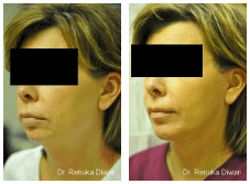 2016-11-11-10_55_35-chin-augmentation-before-after-gallery