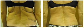 2016-11-11-11_03_53-liposuction-before-after-gallery