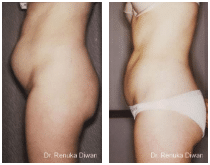 2016-11-15-14_13_30-liposuction-before-after-gallery