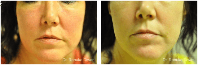 2016-11-17-09_44_29-laser-for-veins-and-redness-before-after-gallery