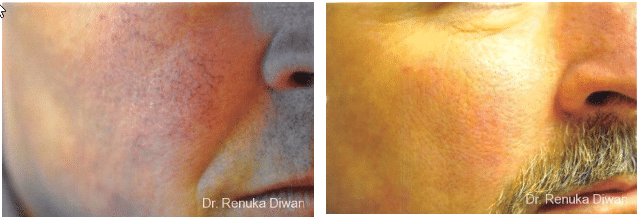 2016-11-17-09_44_46-laser-for-veins-and-redness-before-after-gallery