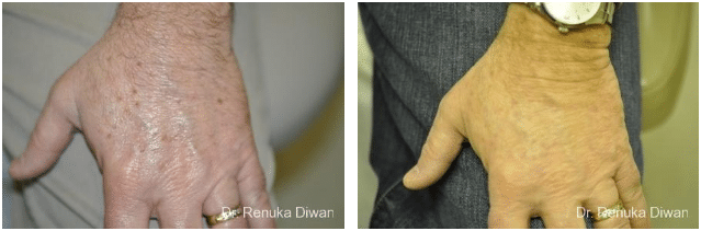 Laser Pigmentation Treatment for Brown Spots on Hands - Dr Diwan patient photo