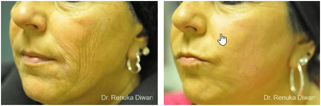 laser resurfacing before and after photo - Dr Diwan