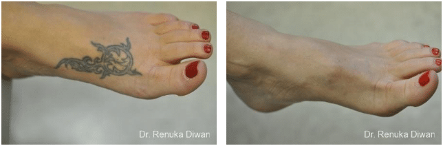 patient’s foot before and after tattoo removal, tattoo invisible after treatment