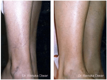 Sclerotherapy before and after 