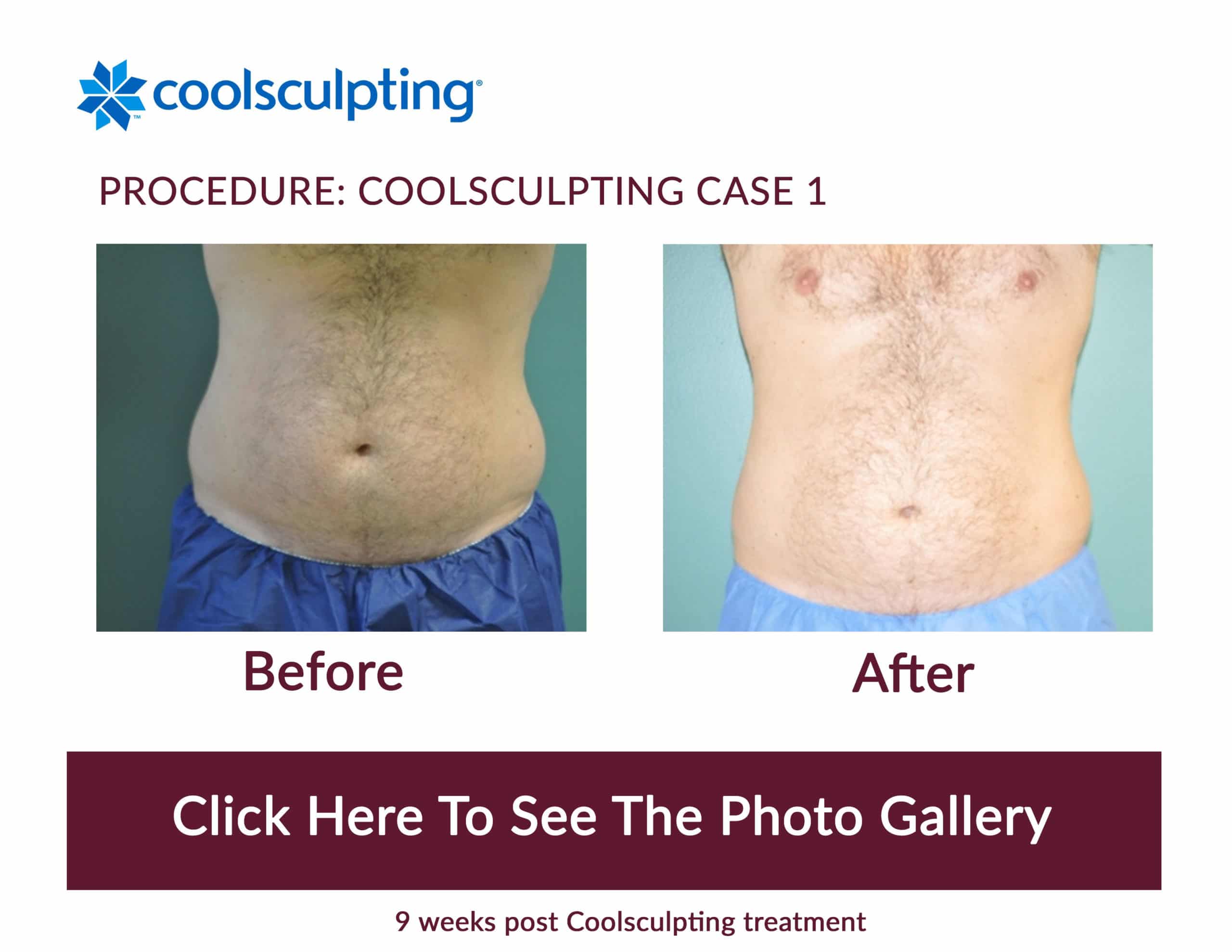 CoolSculpting Before & After