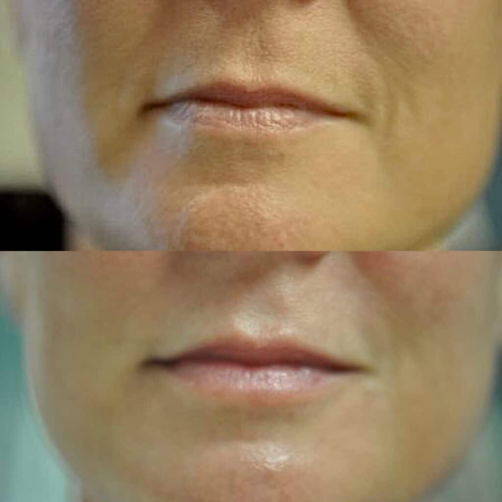 Juvederm in Cleveland, Westlake, Strongsville OH | Dr. Renuka Diwan