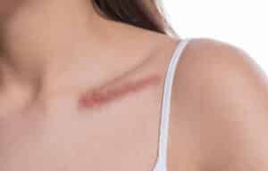 Close up of a woman with a scar on her clavicle, in need of scar revision treatment in Westlake, OH