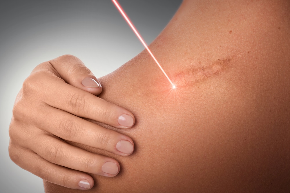 Woman treats a scar on her shoulder with a laser treatment.
