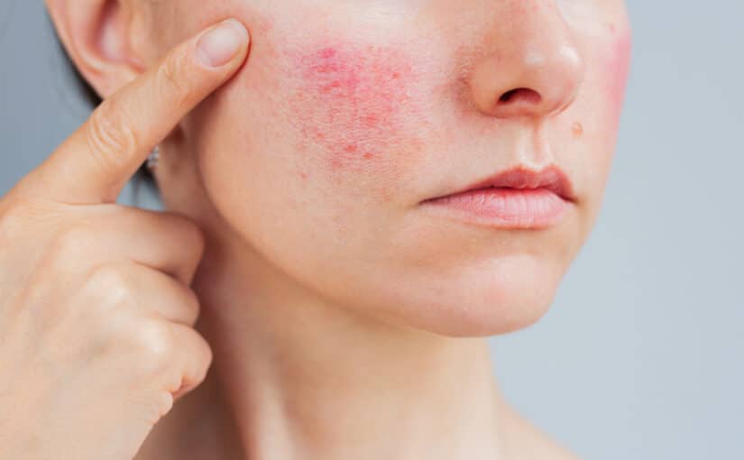 Can IPL Improve Both Redness and Brown Spots at the Same Time?